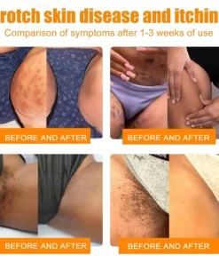 BBOJI™ Bee Venom Wart & Tag Removal Cream