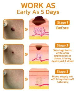 BeeGuard™ Bee Venom Mole and Wart Treatment Cream