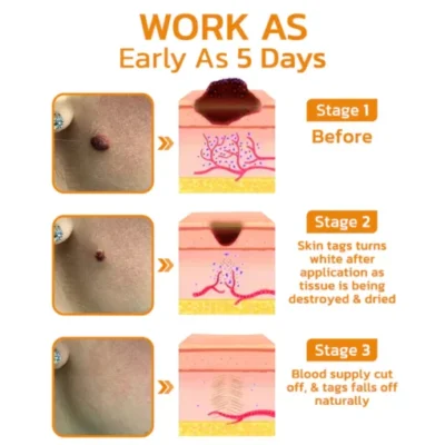 BeeGuard™ Bee Venom Mole and Wart Treatment Cream