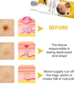 BeeVenux™ Skin Tags Spots & Mole Remover