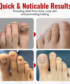 Biancat™ Japanese NailRenew Onychomycosis Swift Relief Oil