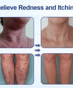 Biancat™ Ocean Aqua Soothe Eczema Relief Cream