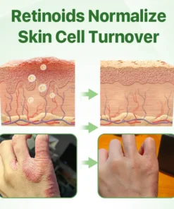 Biancat™ Psoriasis Relief Crocodile Oil Soap