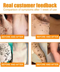 Brezey™ Bee Venom Mole and Wart Treatment Cream