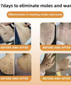 Brezey™ Bee Venom Mole and Wart Treatment Spray