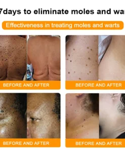 Brezey™ Bee Venom Mole and Wart Treatment Spray