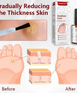 Ceoerty™ FootEase Corn Eliminator Gel
