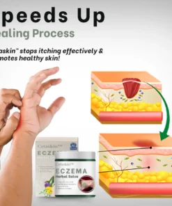 Cetaskin™ Eczema Herbal Salve