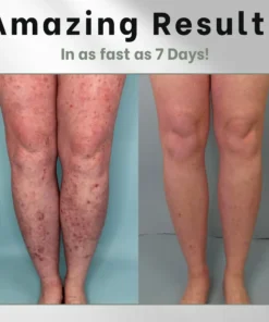 Cetaskin™ Eczema Herbal Salve