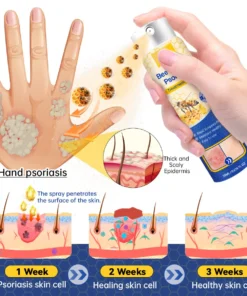 CroAie™ PsoriaHeal Bee Venom Psoriasis Treatment Spray plus