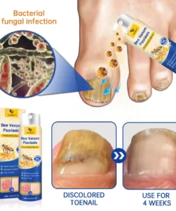 CroAie™ PsoriaHeal Bee Venom Psoriasis Treatment Spray plus