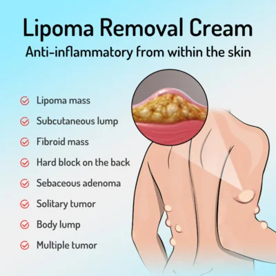Cvreoz™ Bee Venom Lipoma Removal Cream
