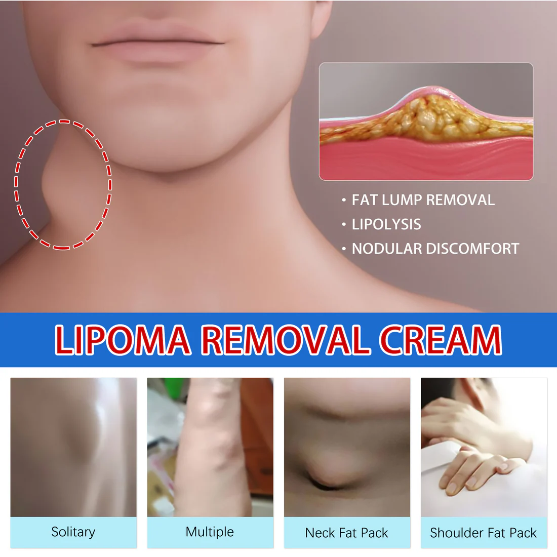 Cvreoz™ Bee Venom Lipoma Removal Cream