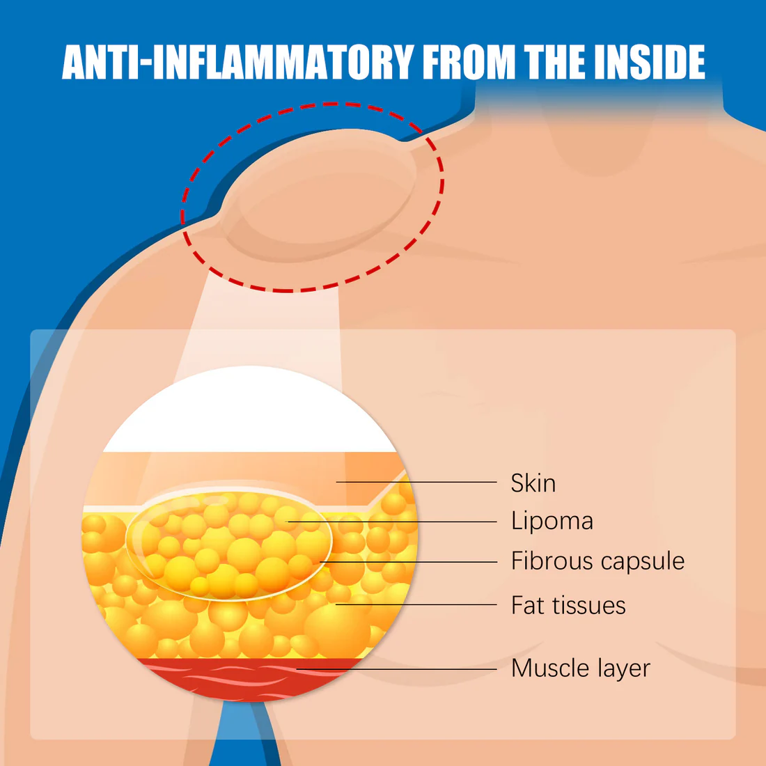 Cvreoz™ Bee Venom Lipoma Removal Cream