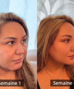 Cvreoz™ Le patch amincissant au venin d'abeille