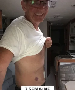 Cvreoz™ Le patch amincissant au venin d'abeille