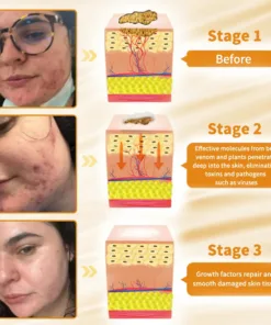 Cvreoz™ Natural Bee Venom Skin Disease Treatment Cream