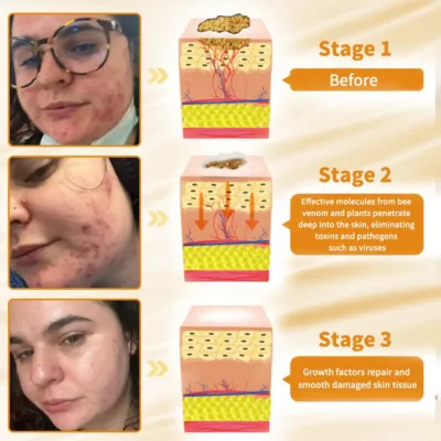 Cvreoz™ Natural Bee Venom Skin Disease Treatment Cream