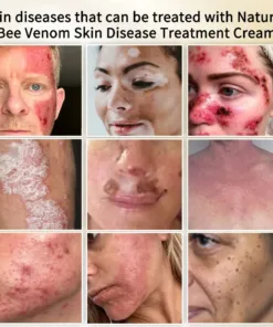 Cvreoz™ Natural Bee Venom Skin Disease Treatment Cream