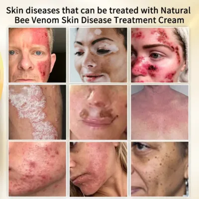 Cvreoz™ Natural Bee Venom Skin Disease Treatment Cream