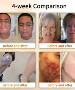 Cvreoz™ Natural Bee Venom Skin Disease Treatment Cream