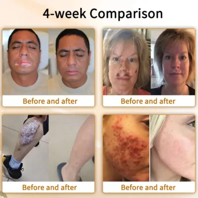 Cvreoz™ Natural Bee Venom Skin Disease Treatment Cream