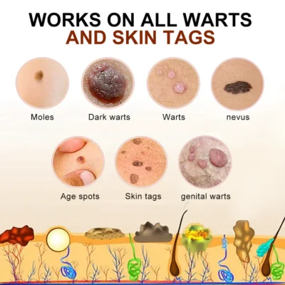 Cvreoz™ PRO Bee Venom Mole and Wart Treatment Cream