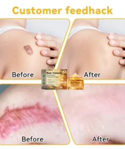 DOCTIA™ Bee Venom Medical Grade Scar Remove Advanced Gel