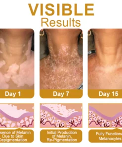 Dobshow™ BeeVenom Vitiligo Treatment Cream