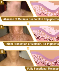 Dobshow™ BeeVenom Vitiligo Treatment Cream