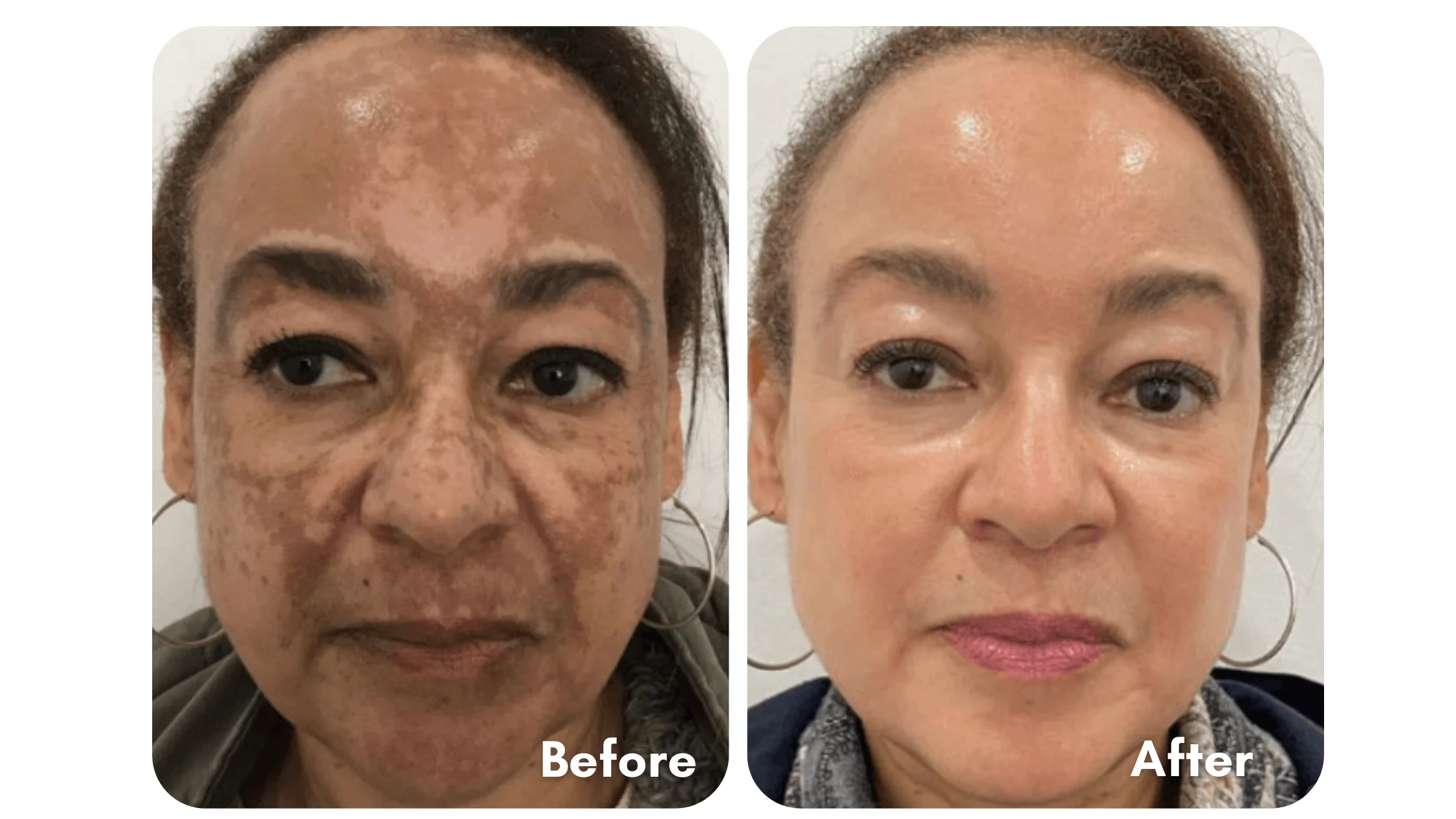 AQA™ Whitening Skin Melanin Correcting Facial Serum