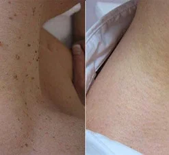 Dobshow™Bee Venom Mole and Wart Treatment Cream