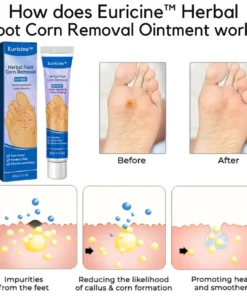 Euricine™ Herbal Foot Corn Removal Ointment