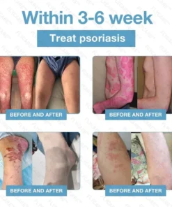 FLYCARE™ Bee Venom Antifungal Cream