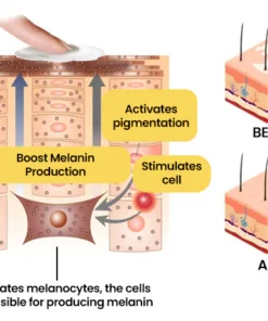 FLYCARE™ Bee Venom Vitiligo Cream