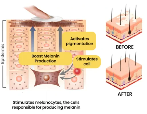 FLYCARE™ Bee Venom Vitiligo Cream