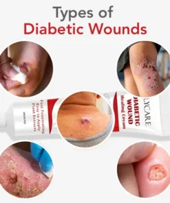 FLYCARE™ Diabetic Wounds Healing Cream