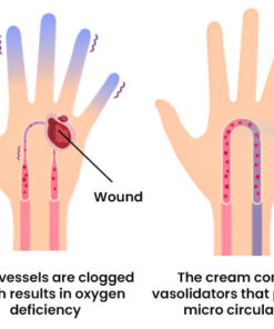 FLYCARE™ Fast Diabetic Wounds Healing Spray