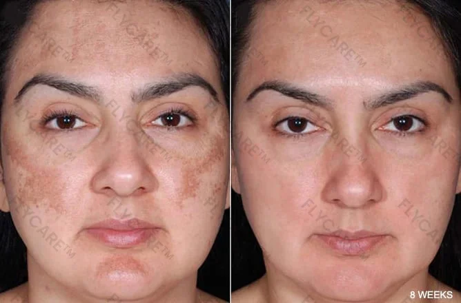 FLYCARE™ Skin Melanin Correcting Facial Serum
