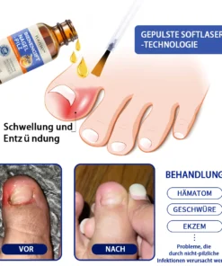 Furzero™ Bienengift Nagelpilz Behandlungslösung