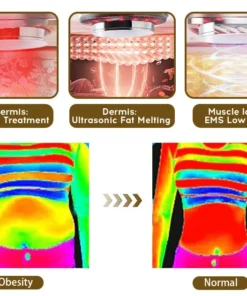 Furzero™ EMS Ultrasonic Far Infrared Anti-Cellulite Massager