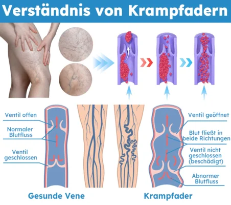 Furzero™ Escin Krampfader-Spray