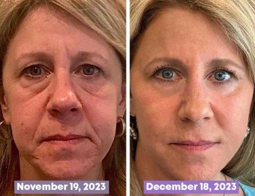 Furzero™ Medika 1.5% Bakuchiol Visible Regenerative Complex