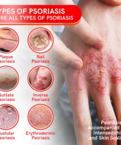 Furzero™ Multi-Symptom Bee Venom Psoriasis Treatment Spray