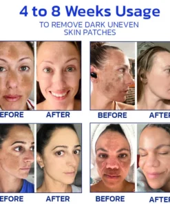 Furzero™ NonSpot Bee Venom Pigment Correction Cream