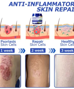 Furzero™ OceanCure Bee Venom Psoriasis & Wart Healing Cream