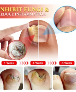 Furzero™ PsoriaKing Psoriasis Antibacterial Treatment Cream