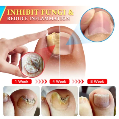 Furzero™ PsoriaKing Psoriasis Antibacterial Treatment Cream