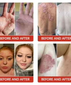 Furzero™ PsoriaKing Psoriasis Antibacterial Treatment Cream