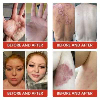 Furzero™ PsoriaKing Psoriasis Antibacterial Treatment Cream